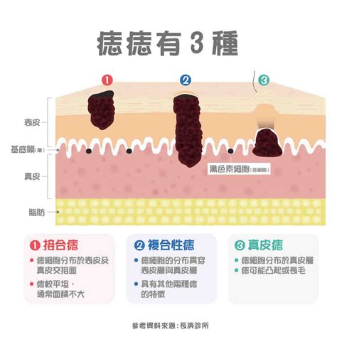 臉部 痣|痣變大、痣多或長毛會變皮膚癌？認識痣的形成與原因